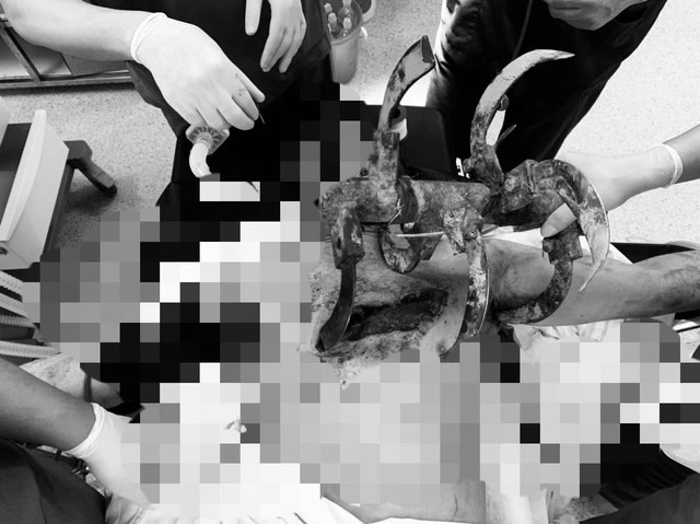 Tai nạn kinh hoàng, người nông dân nhập viện với lưỡi cày cắm sâu vào ngực