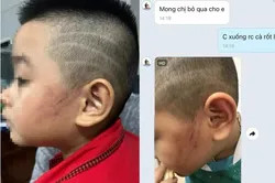 Phụ huynh tố cô giáo mầm non Việt Úc đánh bé trai bầm tím mặt ở Cần Thơ