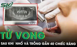 Nhổ và trồng 35 chiếc răng trong một ngày, người đàn ông tử vong