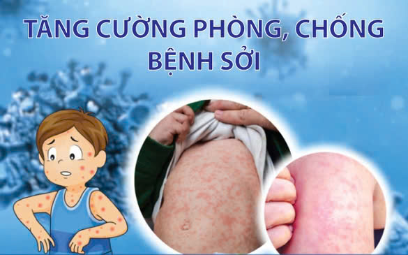 Infographics: Tăng cường công tác phòng, chống bệnh Sởi