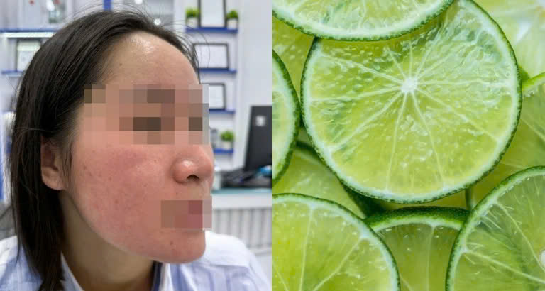 Lãnh hậu quả sau 1 tuần trị mụn bằng nước cốt chanh