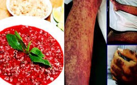 Ghi nhận các ca nhiễm bệnh liên cầu lợn gia tăng