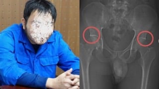 Cố ý đục vỡ xương khớp để trục lợi: Hành vi tàn nhẫn, coi thường sức khoẻ tính mạng