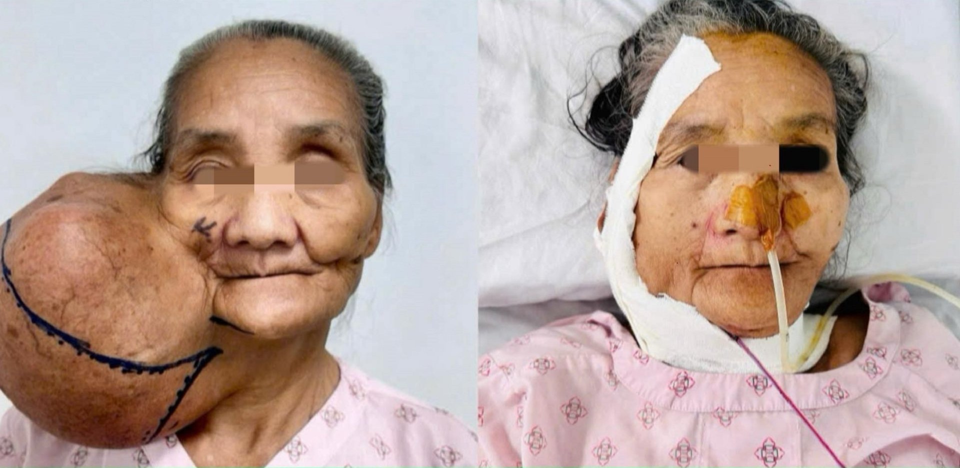 Phẫu thuật cắt thành công khối u khổng lồ trên mặt người phụ nữ 63 tuổi