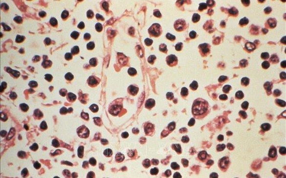 Virus Hanta: Xác nhận 6 ca nhiễm, nguy cơ lây lan toàn cầu ở mức thấp